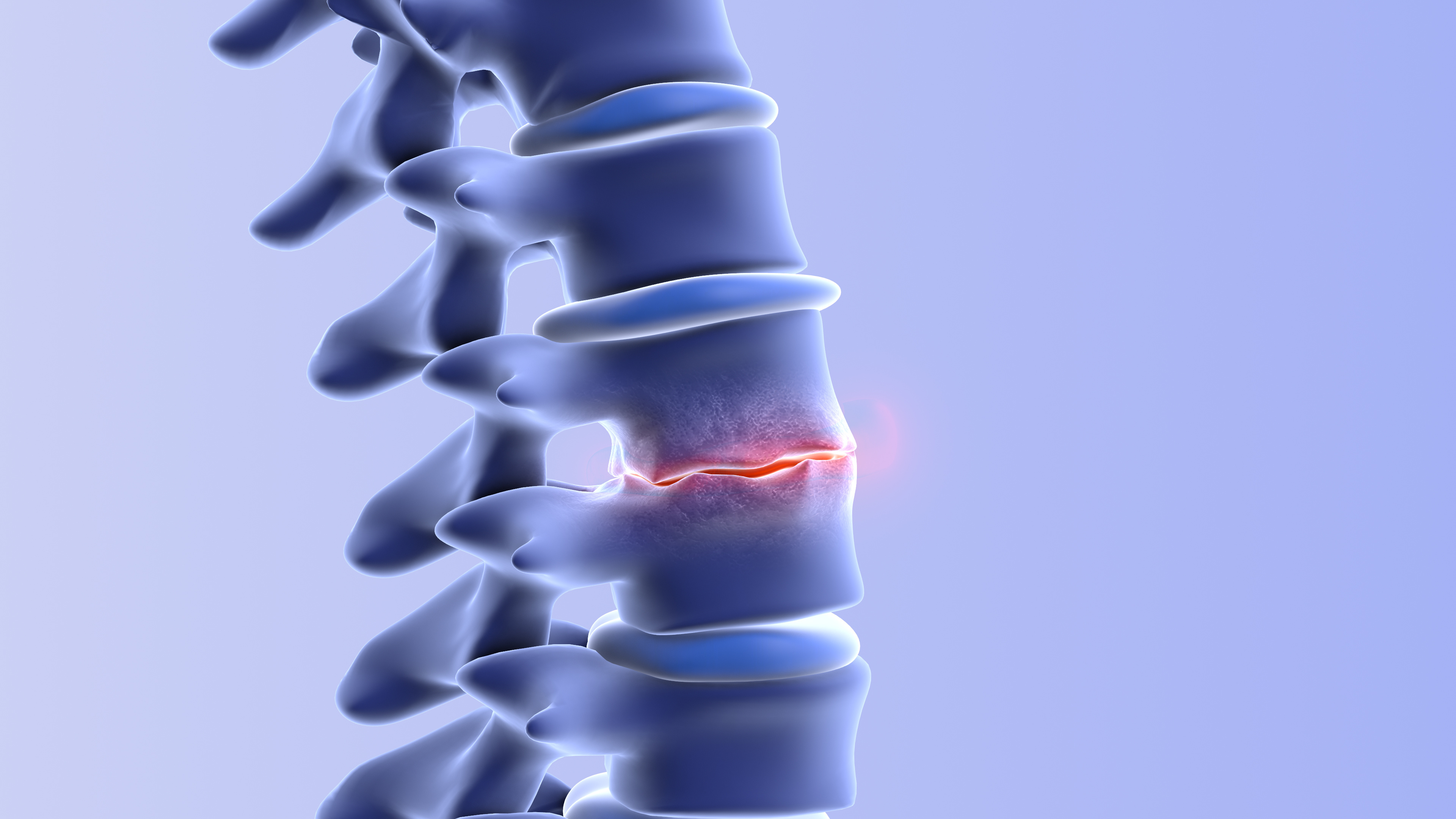 3D illustration of a degenerating spinal disc showing inflammation between vertebrae